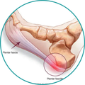 Plantar Fasciitis