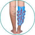 Venous Insufficiency 
