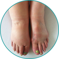 Lymphedema