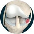 Meniscus Tear