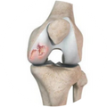 Worn-out cartilage