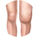 Swelling and stiffness